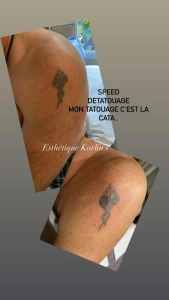 détatouage laser Vertou