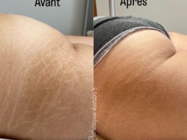 La pratique du tatouage thérapeutique essaime en France depuis quelques années.